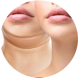 Sahara cosmo [Recovered]_Double Chin and Face Tightening