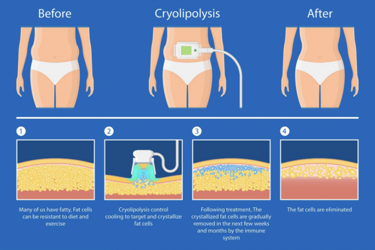 cryolipo is effective treatment, body Sculpting treatment, Cryolipo, Cryolipo treatment